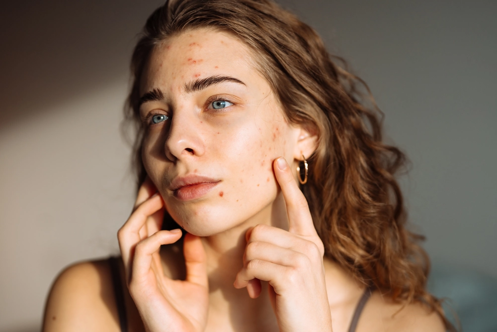 Illustration representing acne and skin care treatment.