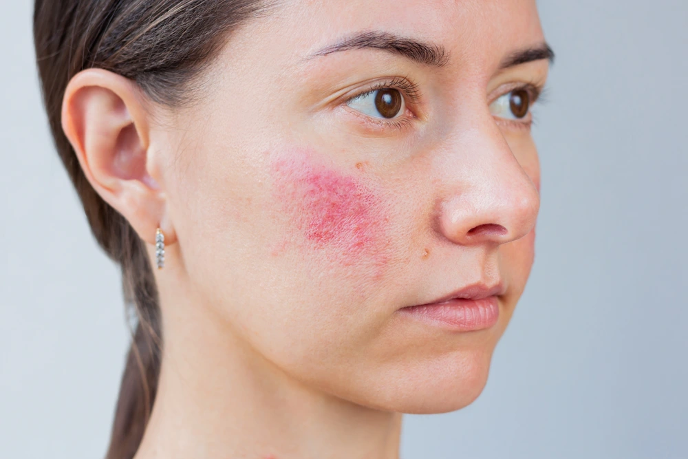 Illustration representing rosacea and gentle skincare.